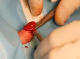 circumcision-08-big-2
