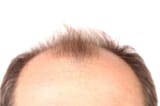 top-of-head-with-receding-hairline