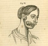 670px-Phossy_jaw