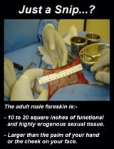 circ_foreskin_sq_cm