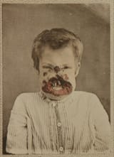 Syphilis_face_1