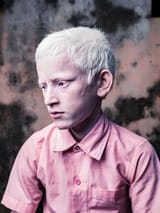 indian albino kid