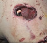 Infected_wound