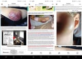 gardasil-turbo-cancer