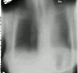 Tomosynthesis_of_chronic_fibrosing_pulmonary_aspergillosis