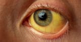 Endfassung_iclinic.at_Gelbe_Augen_web