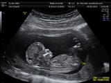 Ultrasound