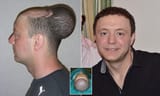 Balding Treatment