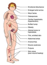 Cushings-syndrome2