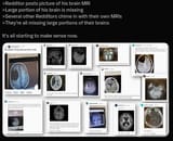 redditors missing large portions of their brains maybe SSRI 1739038488781922