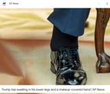puffy ankles