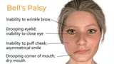 bells-palsy-treatment-propel-physiotherapy