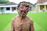 leprosy