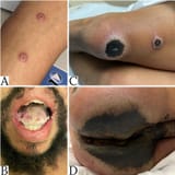 This-figure-demonstrates-newly-developing-monkeypox-lesions-along-the-left-forearm-and-in