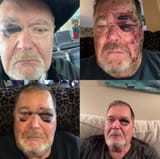 jim-ross-black-eyes-2122467437