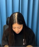 hairloss