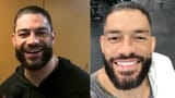 roman-reigns-teeth-before-after