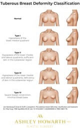 tuberous-breast-classification