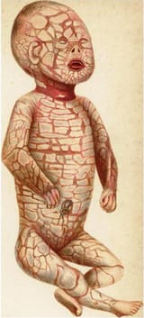 Harlequin_fetus