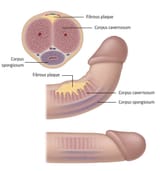 Curved+Penis+Urologist+Toowoomba+Dr+Nikhil+Sapre