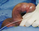Plaque_removal_surgerybefore