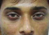Before_HA_filler