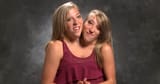 conjoined-twins
