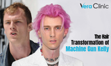 transplantn