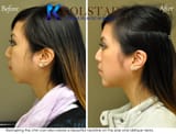 Chin-Augmentation-San-Diego-92