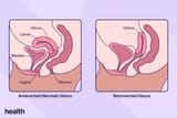 HDC-INFOGRAPHIC-RETROVERTEDUTERUS-1-FINAL-2-1-6d47451d1e1d445c97f57677346ebc94