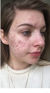 acne2
