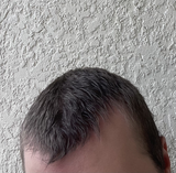 hairline