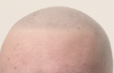 Bald hairline