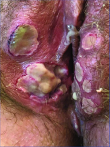 Deep-extensive-confluent-and-well-defined-acute-vulvar-genital-ulcers-with