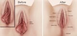 labiaplasty_diagram