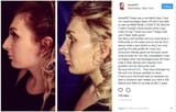 laura loomer nosejob