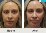 carolina-facial-plastics-lower-blepharoplasty-female-before-after-charlotte3