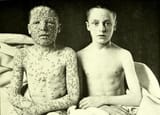 young boy with small pox