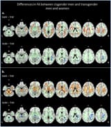 Whole-brain-voxel-wise-group-differences-in-FA-p-005-FWE-corrected-between-homo-and