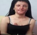 acid