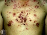 acne-fulminans-2