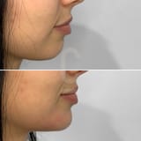 Chin-Augmentation-Female-7