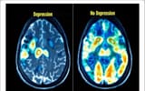 An-example-of-depression-and-normal-brain-by-MRI-Image-is-from-https-healt-hpoin[1]