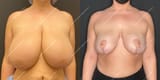 breast-reduction-before-after-KT-AP-3-month-lipo