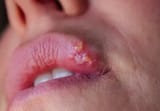 cold-Sore-Lip-1485050089-770x533-1_jpg