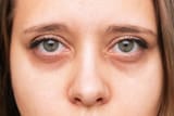 -is-the-difference-between-eye-bags-puffy-eyes-and-dark-circles-healthy-skin-lab
