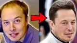 Elon-Musk-Hair-Transplant.jpg1119