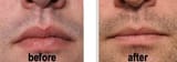 Lip-Reduction-Surgery