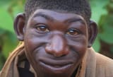 Microcephaly