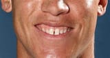 Aaron Judge’s infamous teeth, 